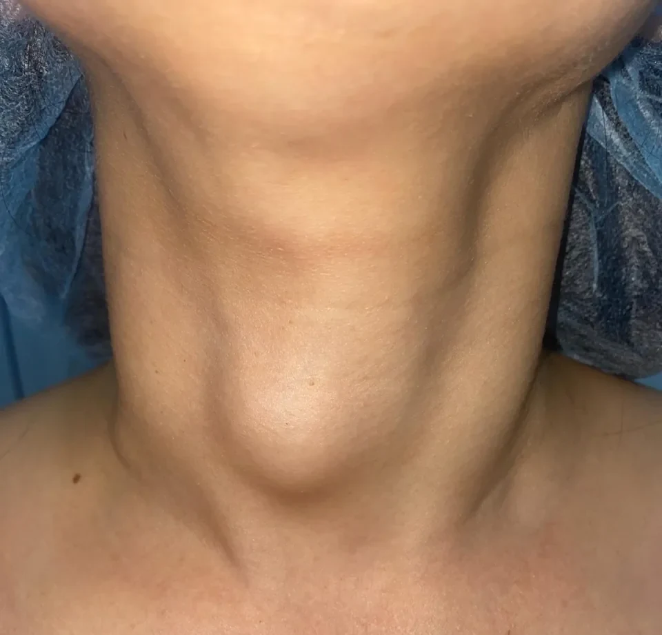 Cuello de la paciente antes de la ablación, con el nódulo visible